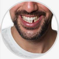 Lost Tooth Fillings & Loose Cap Repair